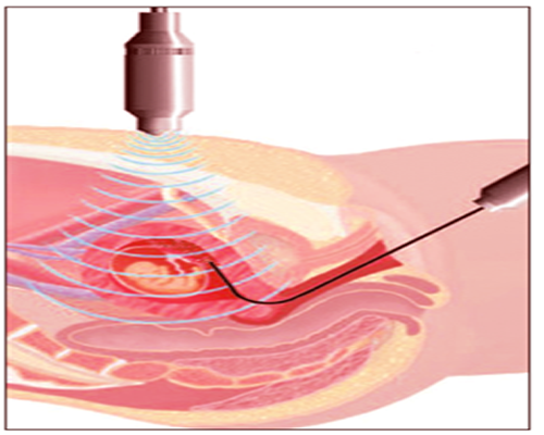 মায়ের গর্ভেই থ্যালাসেমিয়া রোগ নির্ণয় পদ্ধতি