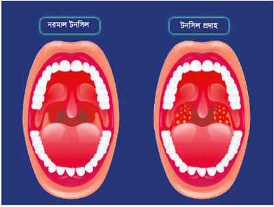 টনসিল অপারেশনের বিষয়ে কিছু তথ্য ॥ অপারেশন কখন করবেন টনসিল অপারেশনের বিষয়ে কিছু তথ্য ॥ অপারেশন কখন করবেন