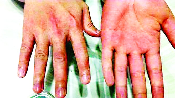 ডেঙ্গু জ্বর