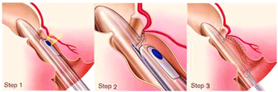 পাইলসের কার্যকরী চিকিৎসা
