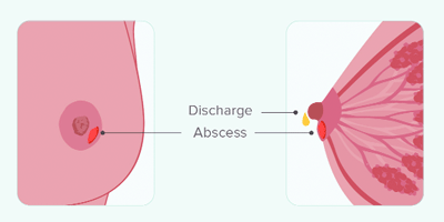 ব্রেস্ট এবসেস বা ইনফেকশন