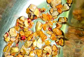 কিডনিতে ২০৬ পাথর ! কিডনিতে ২০৬ পাথর !