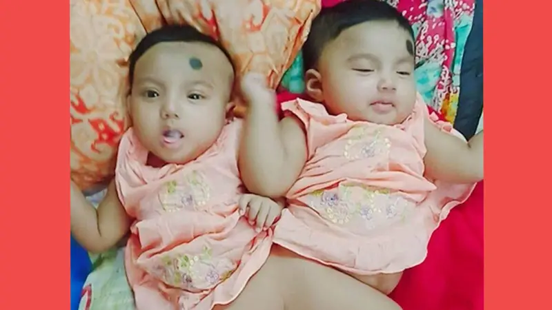 জোড়া লাগা দুই শিশুর চিকিৎসার দায়িত্ব নিলেন প্রধানমন্ত্রী জোড়া লাগা দুই শিশুর চিকিৎসার দায়িত্ব নিলেন প্রধানমন্ত্রী