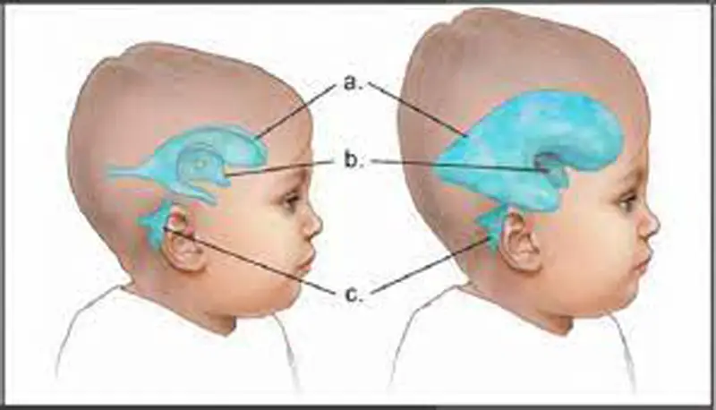 ব্রেনে পানি জমা ও তার প্রতিকার