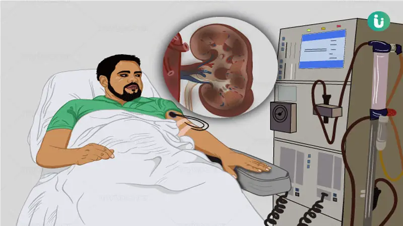 শহরে কিডনি রোগী বেশি কেন, প্রতিকারের উপায় শহরে কিডনি রোগী বেশি কেন, প্রতিকারের উপায়