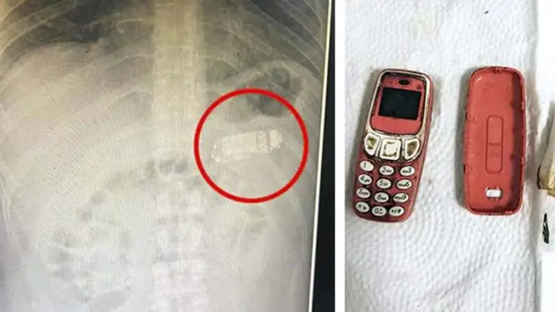গিলে ফেলা আস্ত মোবাইল যেভাবে বের করলেন চিকিৎসকরা গিলে ফেলা আস্ত মোবাইল যেভাবে বের করলেন চিকিৎসকরা
