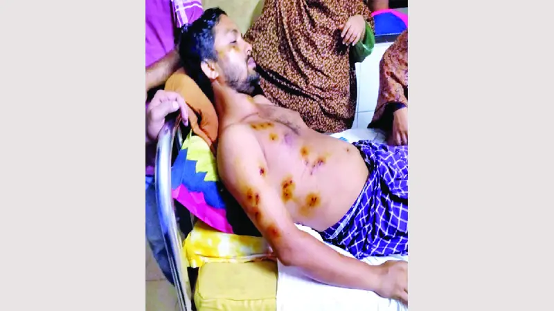 জুলাইযোদ্ধা আলাউদ্দিন এখনো দেহে বয়ে বেড়াচ্ছেন ২২টি ছররা গুলি