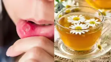 মুখের ঘা দূর করার ১২টি প্রাকৃতিক উপায়