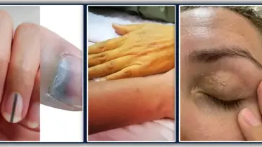 আপনার ত্বকে দৃশ্যমান হৃদরোগের ৭ টি লক্ষণ