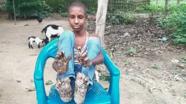 বৃক্ষ শিশু রিপনের আর্তনাদ, টাকার অভাবে চিকিৎসা বন্ধ ৭বছর