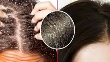 বর্ষা এলেই মাথায় ভরে যায় সাদা সাদা খুশকি? কীভাবে মুক্তি পাবেন?