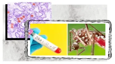 জিকা ভাইরাস ॥ আতঙ্ক নয়, সচেতন হোন