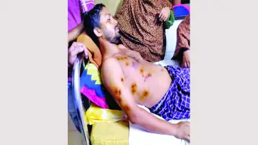 জুলাইযোদ্ধা আলাউদ্দিন এখনো দেহে বয়ে বেড়াচ্ছেন ২২টি ছররা গুলি