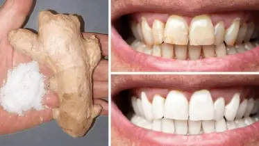 ঘরে বসেই দূর করুন দাঁতের দাগ 
