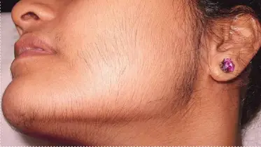 দেশে বাড়ছে পলিসিস্টিক ওভারি সিনড্রোম : কিশোরী ও তরুণীরা বেশি ঝুঁকিতে