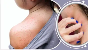 আসছে গরম, ঘামাচি প্রতিরোধের উপায় জানুন