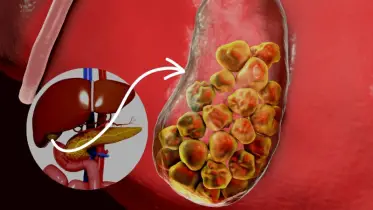পিত্তপাথর: কী খাওয়া উচিত ও কী পরিহার করবেন