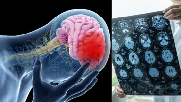 ব্রেন স্ট্রোক পরবর্তী সুস্থ হওয়ার এক যুগান্তকারী ওষুধ আবিষ্কার!
