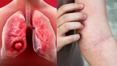 ত্বকের যে লক্ষণগুলো হতে পারে ফুসফুস ক্যান্সারের উপসর্গ!