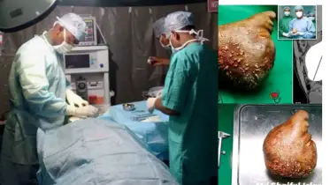 পেটে গ্যাস্ট্রিক নয়, ছিল ১৩ সেমি দৈত্য ওজন ৮০০ গ্রাম!