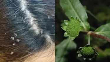 চুলে খুশকি বা উকুন? কালোকেশিই হতে পারে সমাধান!