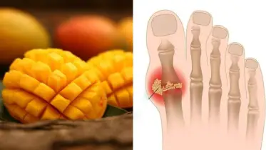 আম খেলে ইউরিক অ্যাসিড বাড়বে?