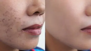 মুখের ব্রণ ও দাগ কমাতে প্রাকৃতিক সমাধান