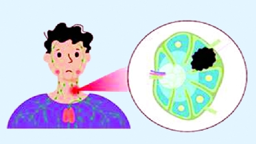 লসিকাতন্ত্রের ক্যান্সার ‘লিম্পোমা’