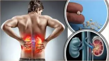 কিডনিতে পাথর কাদের বেশি হয়?