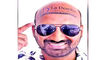 টাক মাথায় বিজ্ঞাপন