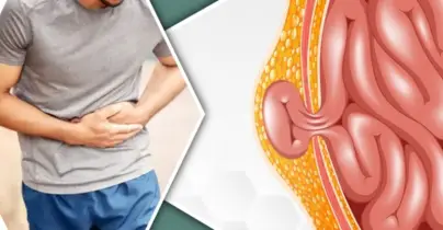 হার্নিয়া কী, কেন হয়, চিকিৎসা কী?