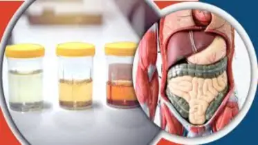 প্রস্রাবের রঙেই লুকিয়ে আছে আপনার স্বাস্থ্য সংকেত! জানান দেবে সুস্থ আছেন কি না