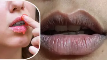 ঠোঁটে কালো দাগ? ঘরেই বসেই দূর করুন এই ৫ উপায়ে!