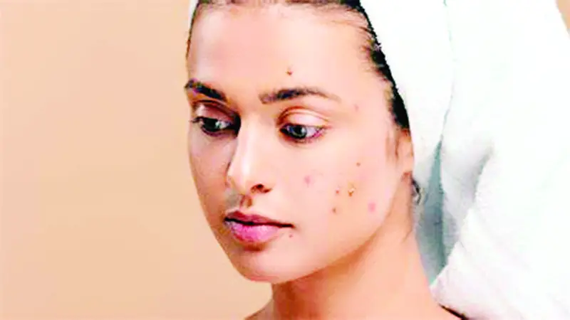যে কারণে মুখে ব্রণ ওঠে যে কারণে মুখে ব্রণ ওঠে