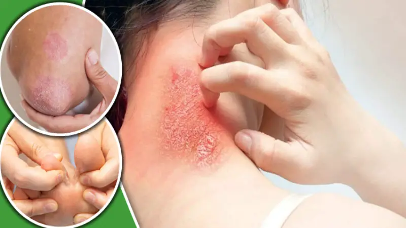ঘাম থেকে ফাঙ্গাল ইনফেকশন: বর্ষায় ত্বক সুরক্ষায় বিশেষজ্ঞদের পরামর্শ ঘাম থেকে ফাঙ্গাল ইনফেকশন: বর্ষায় ত্বক সুরক্ষায় বিশেষজ্ঞদের পরামর্শ