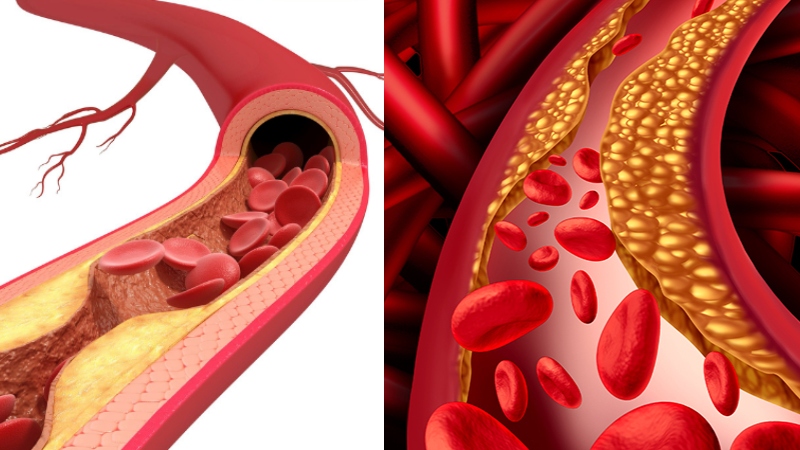 অজান্তেই হার্টের রক্তনালী বন্ধ করছে এই ১০টি ‘হেলদি’ খাবার!
