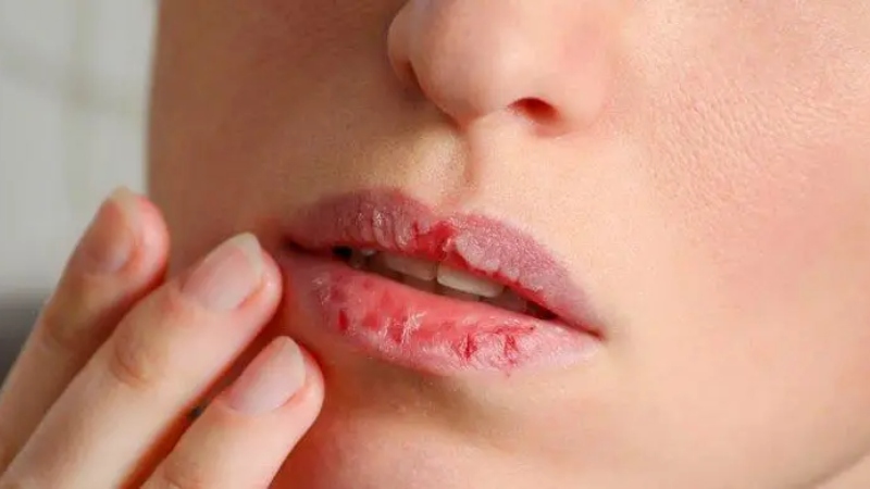 শীতে ফাটছে ঠোঁট, ঘরোয়া উপায়ে কোমল রাখবেন যেভাবে